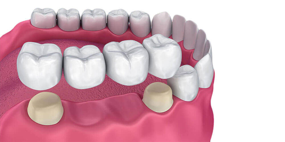 Dental Bridges Etobicoke