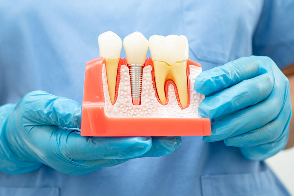 Dental Implants Etobicoke