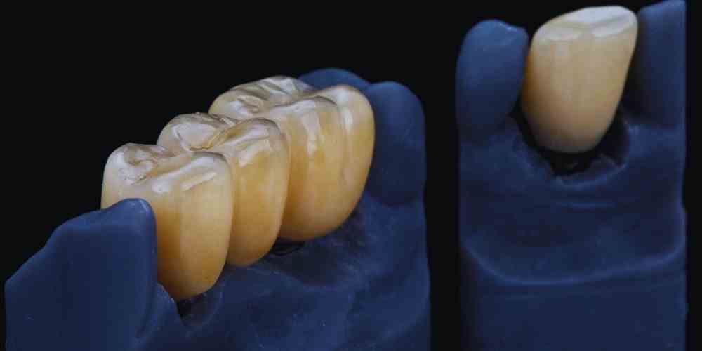 3 Reasons a Dental Bridge Might Not Last