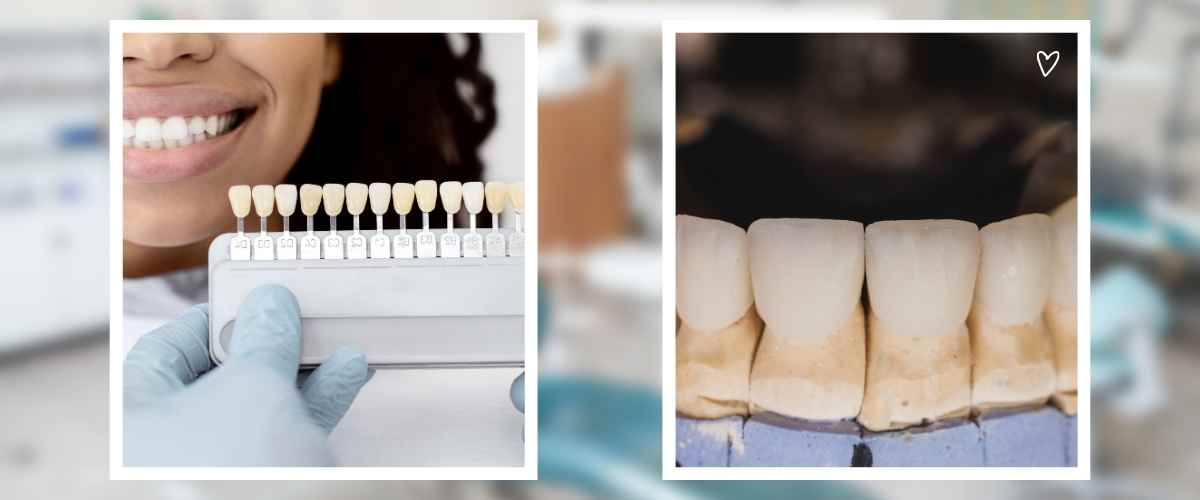 Teeth Bonding vs. Veneers: Which Cosmetic Dental Treatment Is Right for You? Teeth Bonding vs. Veneers: Which Cosmetic Dental Treatment Is Right for You?